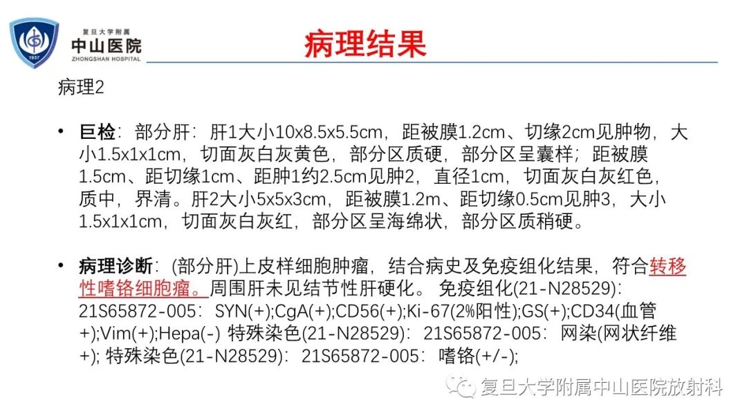 影像PPT - 【病例】肾上腺嗜铬细胞瘤伴转移1例CT及MR影像-14