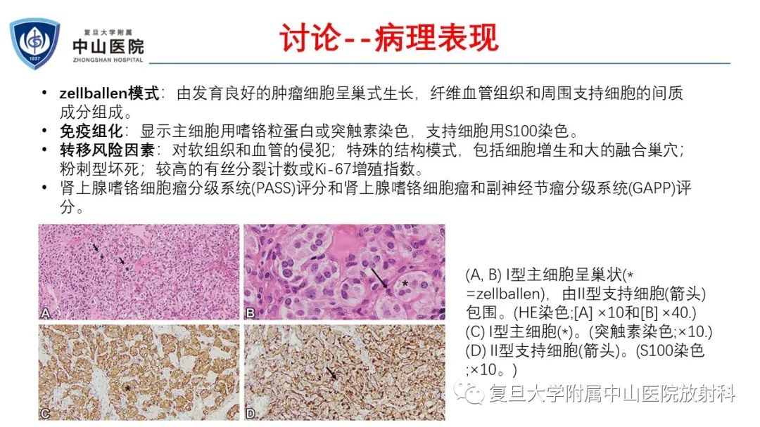 影像PPT - 【病例】肾上腺嗜铬细胞瘤伴转移1例CT及MR影像-18