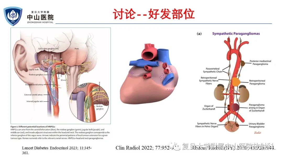 影像PPT - 【病例】肾上腺嗜铬细胞瘤伴转移1例CT及MR影像-19