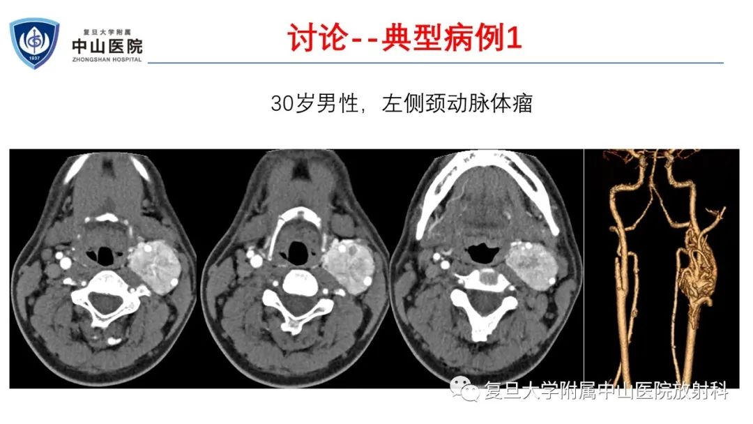 影像PPT - 【病例】肾上腺嗜铬细胞瘤伴转移1例CT及MR影像-22