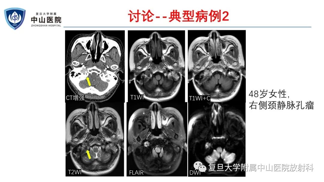 影像PPT - 【病例】肾上腺嗜铬细胞瘤伴转移1例CT及MR影像-23