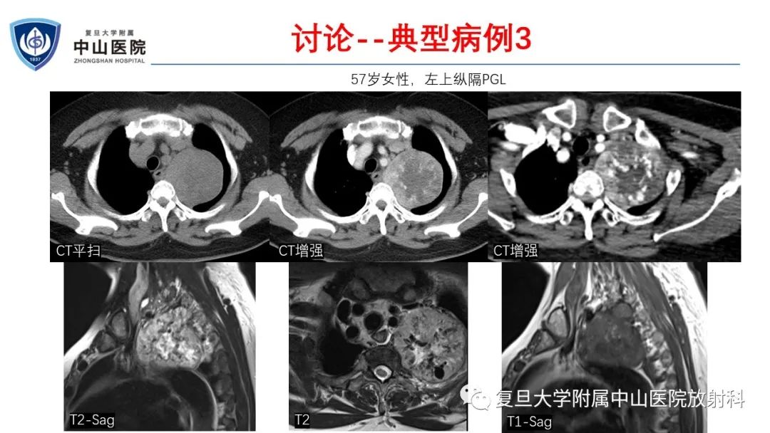 影像PPT - 【病例】肾上腺嗜铬细胞瘤伴转移1例CT及MR影像-24