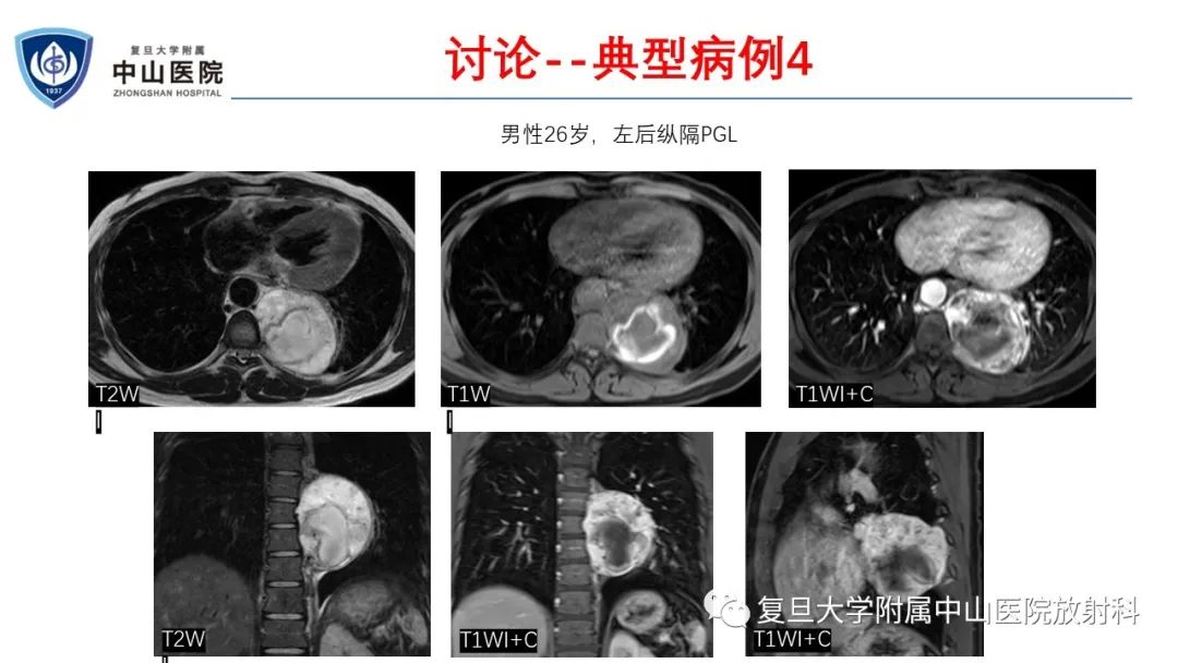 影像PPT - 【病例】肾上腺嗜铬细胞瘤伴转移1例CT及MR影像-25