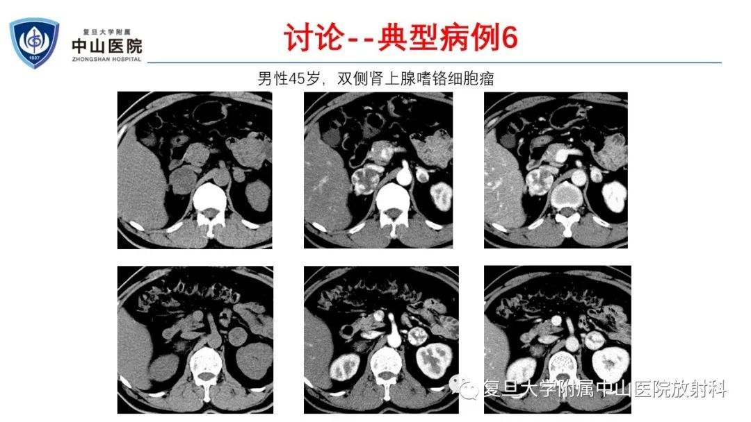 影像PPT - 【病例】肾上腺嗜铬细胞瘤伴转移1例CT及MR影像-27