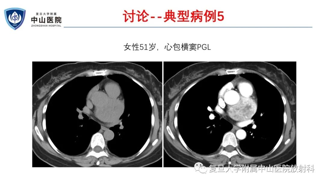 影像PPT - 【病例】肾上腺嗜铬细胞瘤伴转移1例CT及MR影像-26