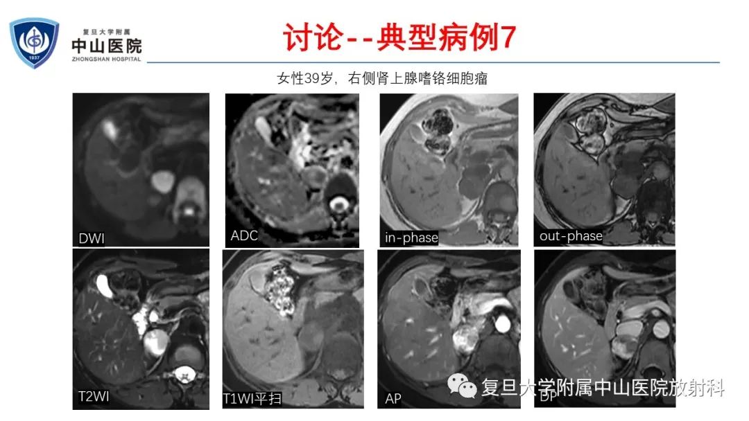 影像PPT - 【病例】肾上腺嗜铬细胞瘤伴转移1例CT及MR影像-28