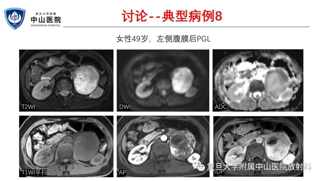 影像PPT - 【病例】肾上腺嗜铬细胞瘤伴转移1例CT及MR影像-29