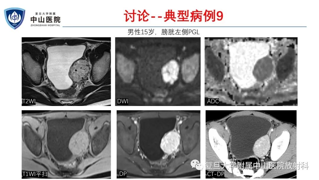 影像PPT - 【病例】肾上腺嗜铬细胞瘤伴转移1例CT及MR影像-30