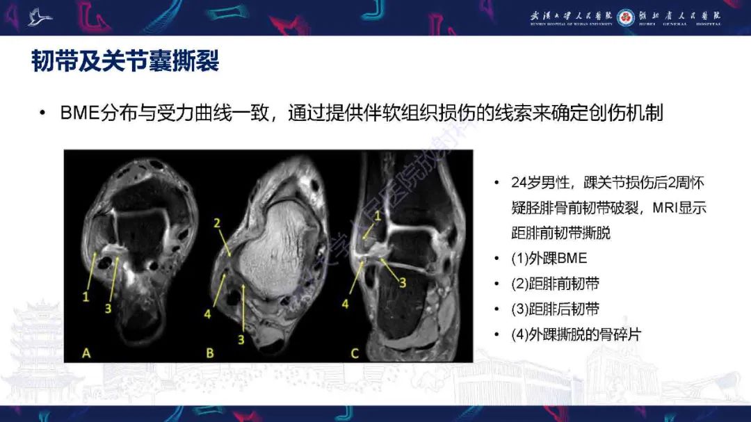 影像PPT - 【PPT】踝关节骨髓水肿MRI诊断-9