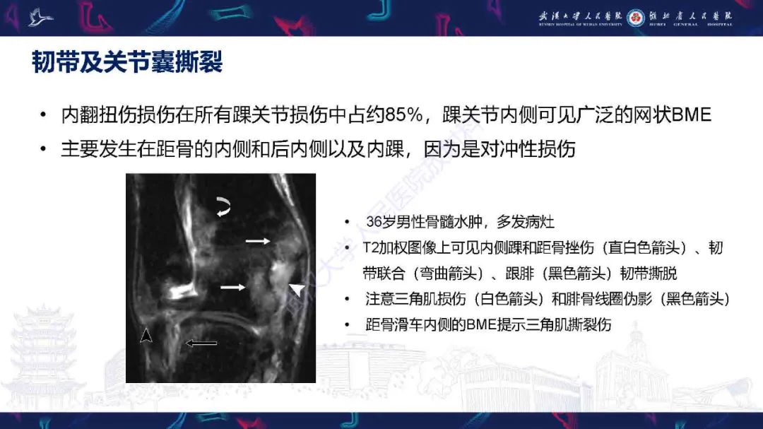 影像PPT - 【PPT】踝关节骨髓水肿MRI诊断-10