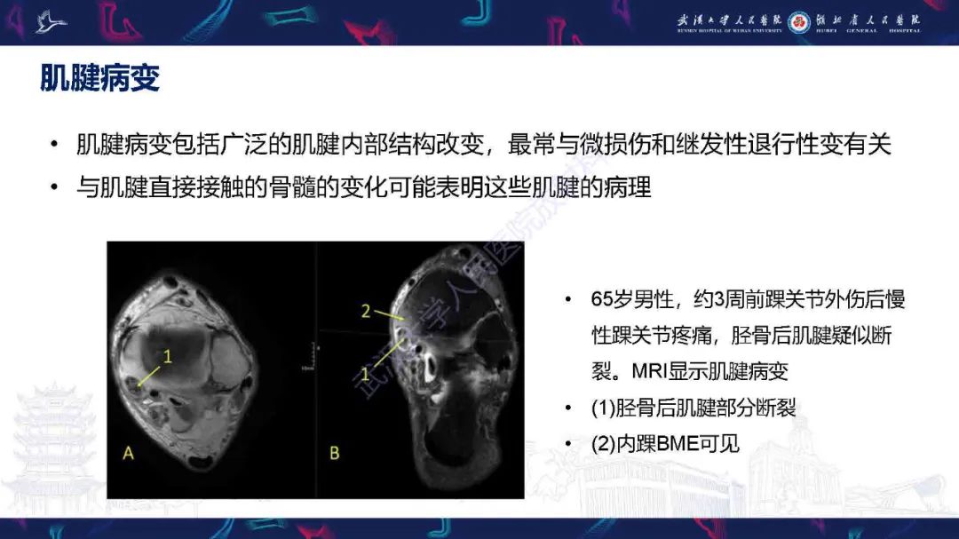 影像PPT - 【PPT】踝关节骨髓水肿MRI诊断-12