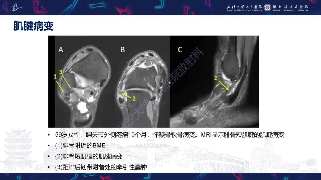 影像PPT - 【PPT】踝关节骨髓水肿MRI诊断-13