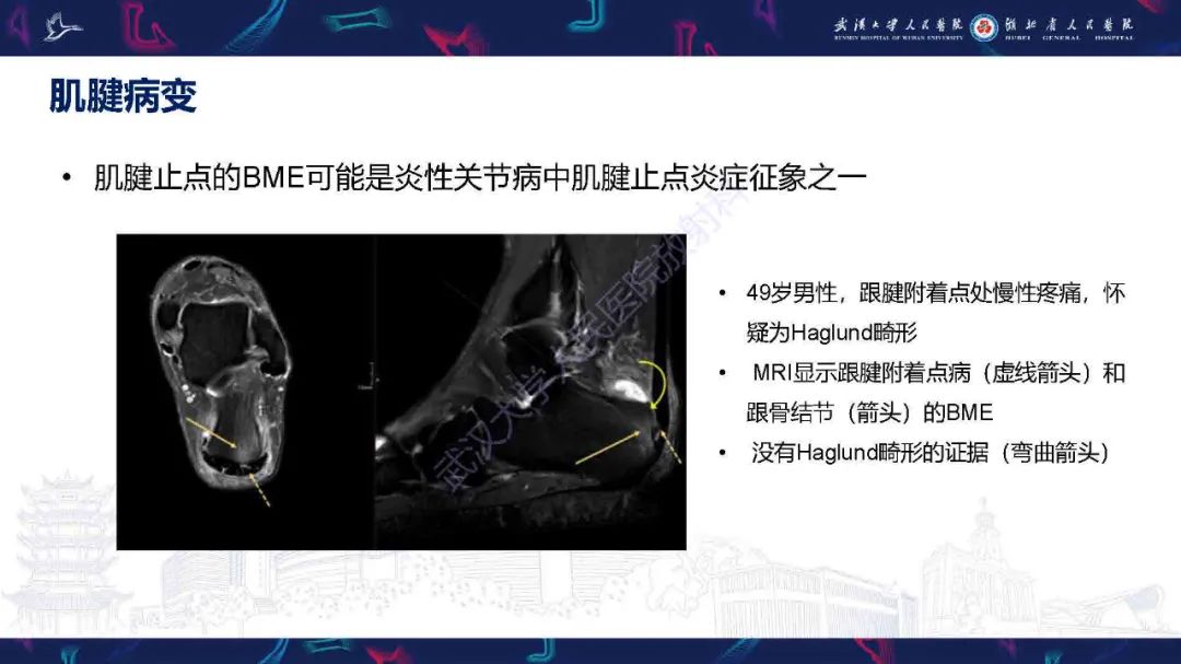 影像PPT - 【PPT】踝关节骨髓水肿MRI诊断-14