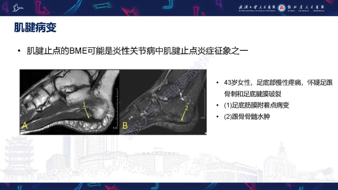 影像PPT - 【PPT】踝关节骨髓水肿MRI诊断-15