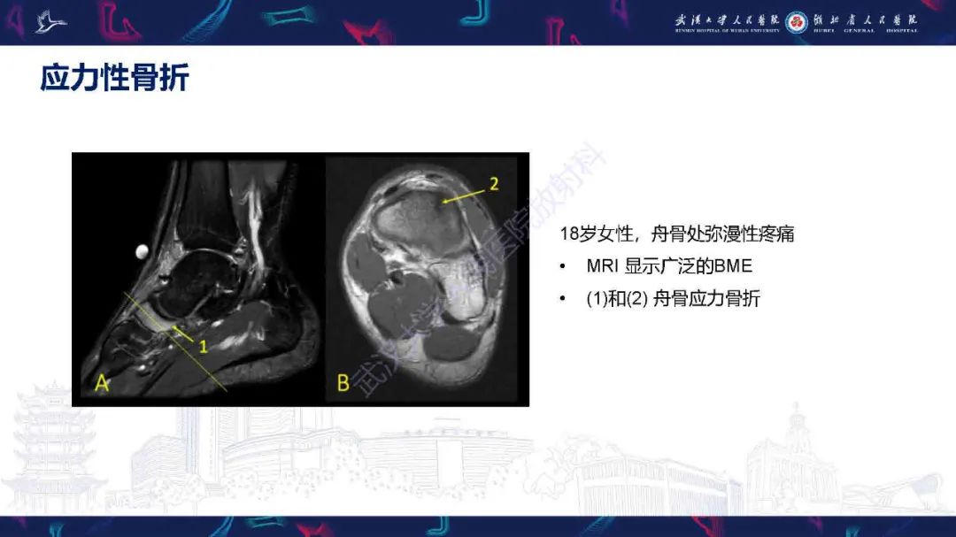 影像PPT - 【PPT】踝关节骨髓水肿MRI诊断-17