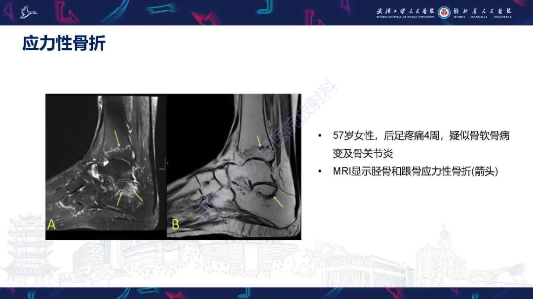 影像PPT - 【PPT】踝关节骨髓水肿MRI诊断-18