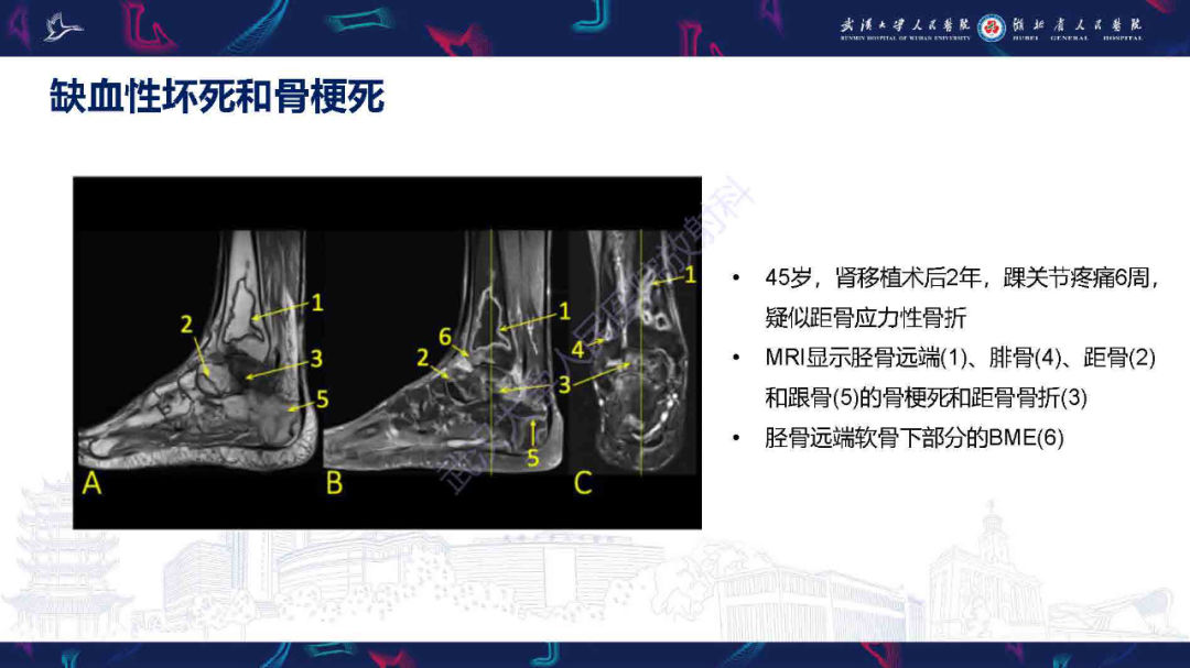 影像PPT - 【PPT】踝关节骨髓水肿MRI诊断-20