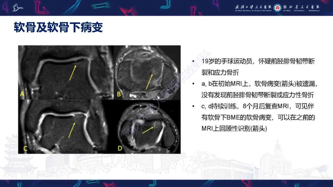 影像PPT - 【PPT】踝关节骨髓水肿MRI诊断-22