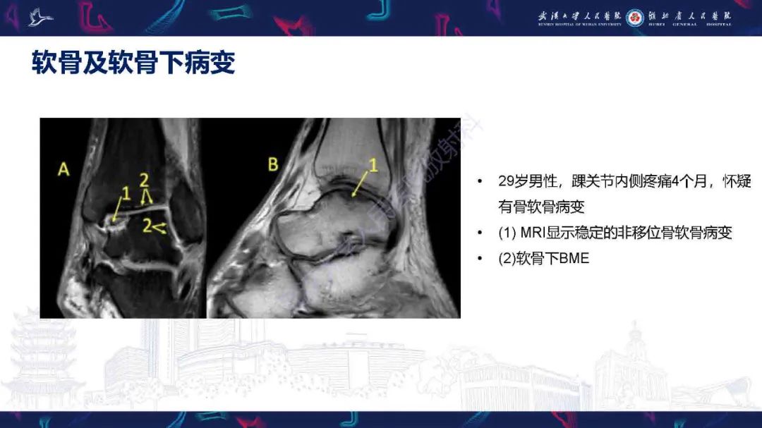 影像PPT - 【PPT】踝关节骨髓水肿MRI诊断-23