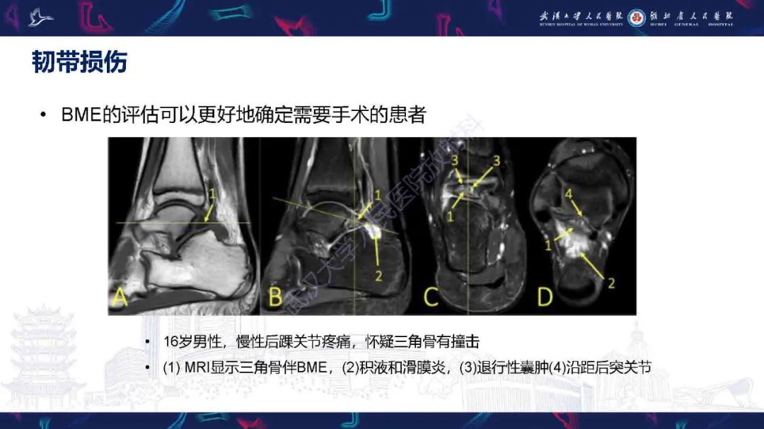 影像PPT - 【PPT】踝关节骨髓水肿MRI诊断-26
