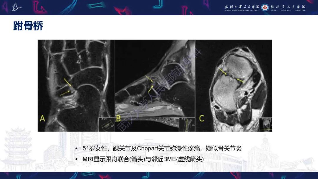 影像PPT - 【PPT】踝关节骨髓水肿MRI诊断-28