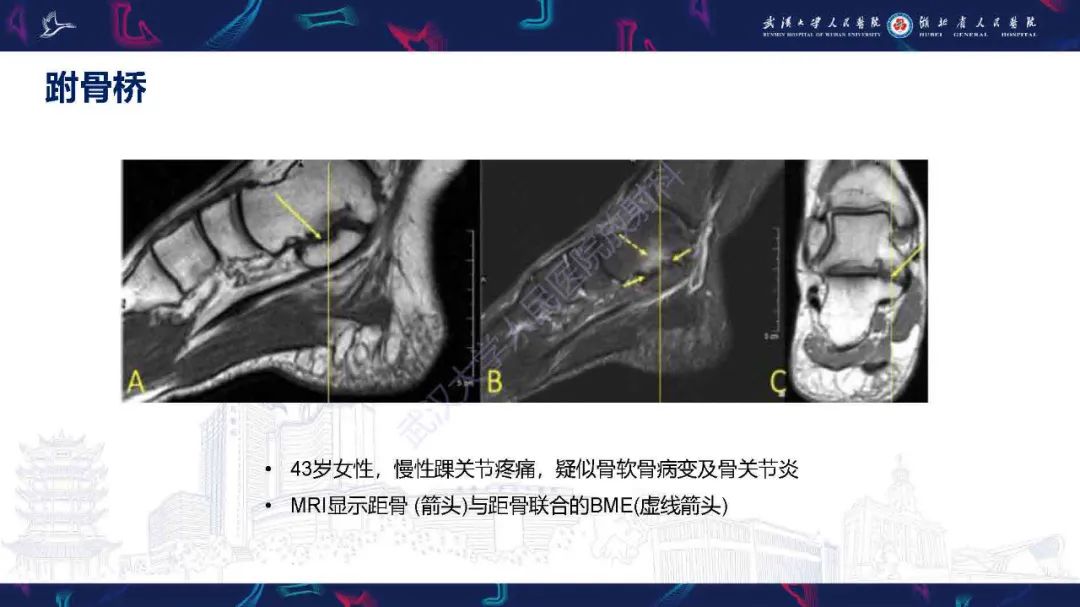 影像PPT - 【PPT】踝关节骨髓水肿MRI诊断-29