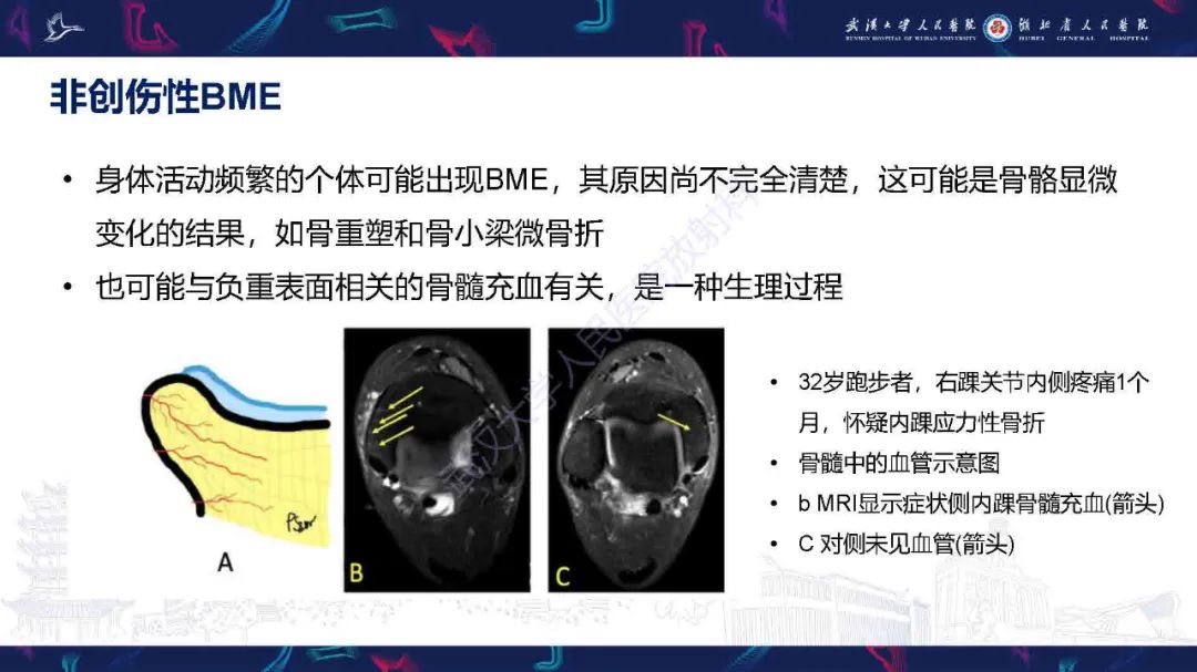 影像PPT - 【PPT】踝关节骨髓水肿MRI诊断-30