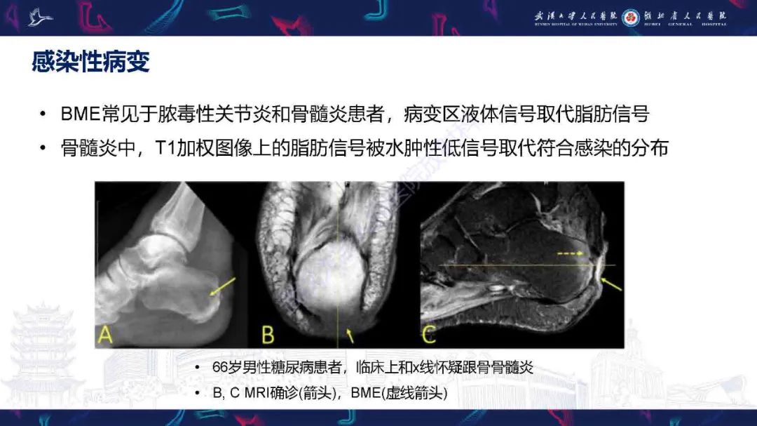 影像PPT - 【PPT】踝关节骨髓水肿MRI诊断-31