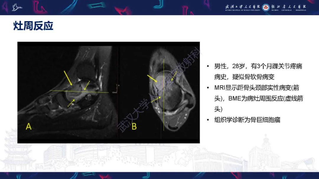 影像PPT - 【PPT】踝关节骨髓水肿MRI诊断-33