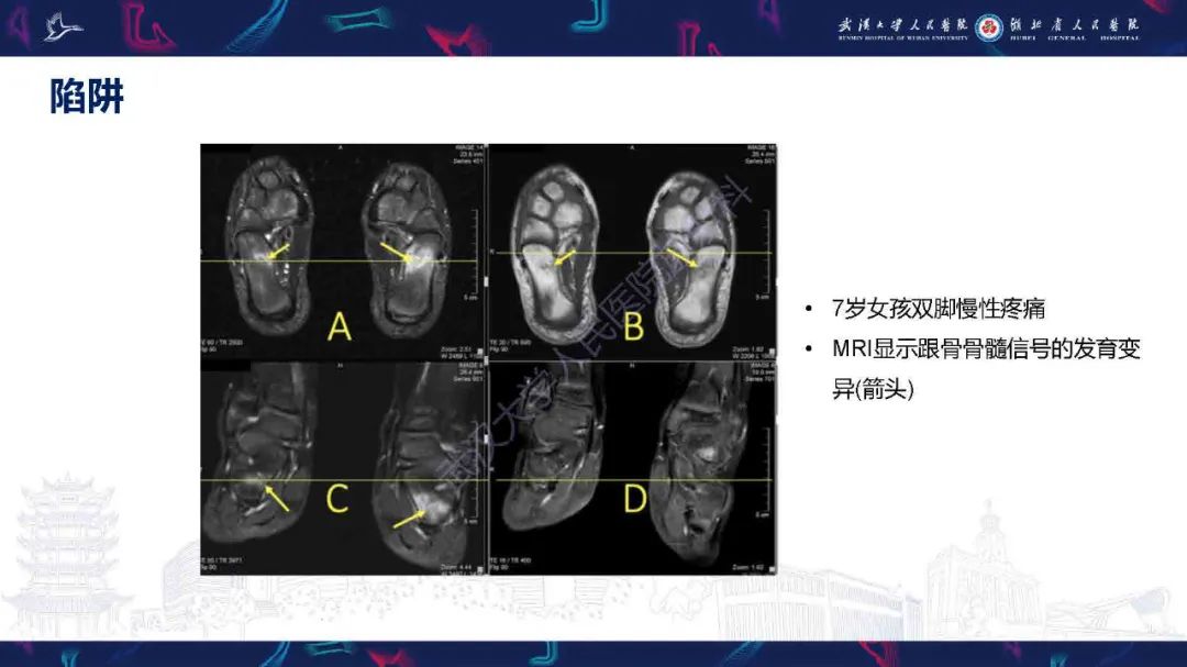 影像PPT - 【PPT】踝关节骨髓水肿MRI诊断-35