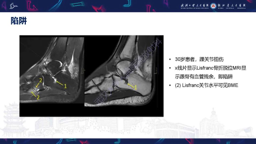 影像PPT - 【PPT】踝关节骨髓水肿MRI诊断-36