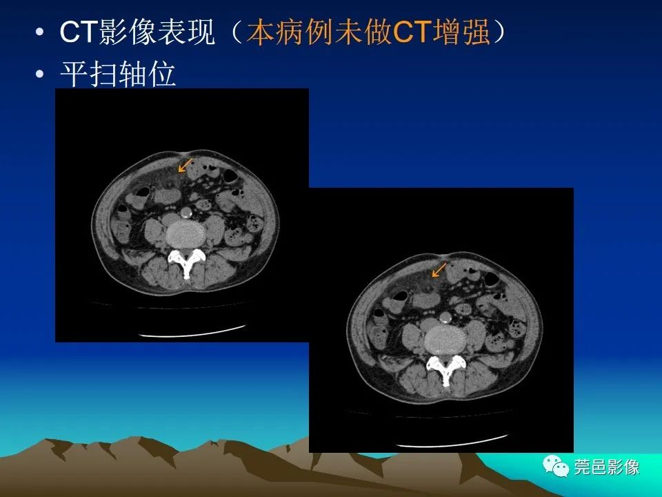 影像PPT - 【病例】大网膜扭转2例CT影像表现-3