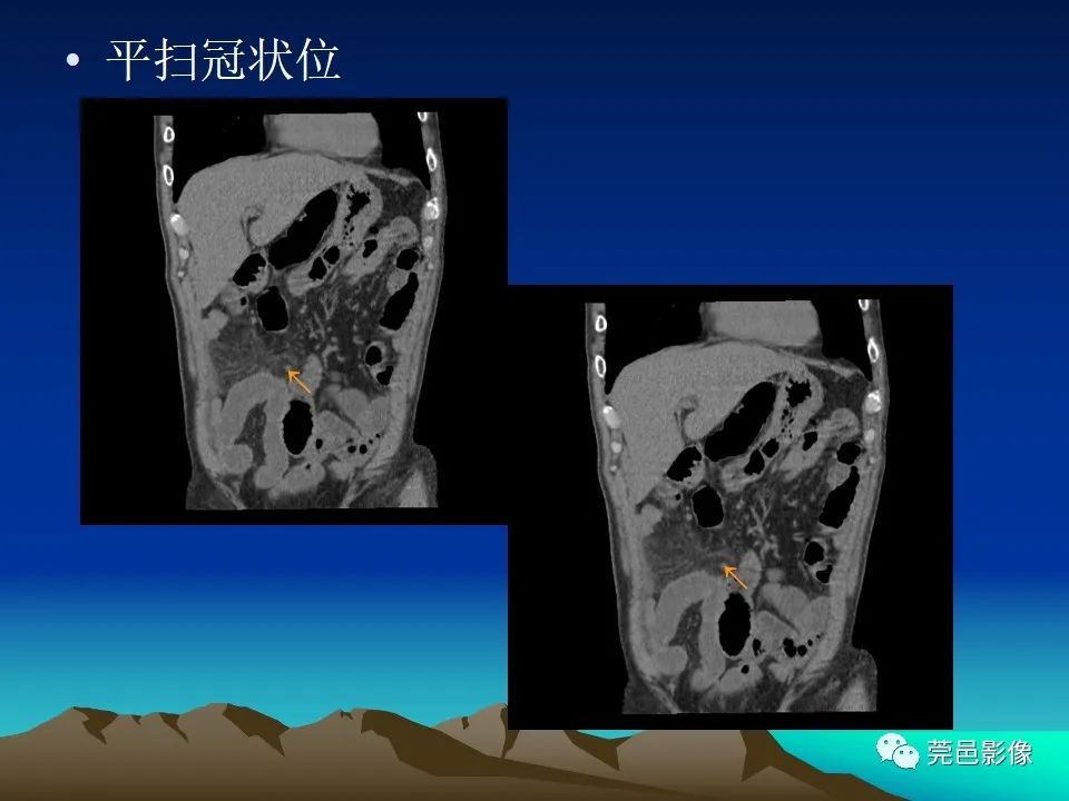 影像PPT - 【病例】大网膜扭转2例CT影像表现-5