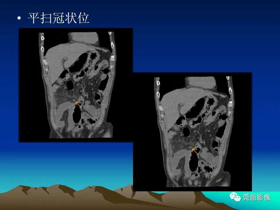 影像PPT - 【病例】大网膜扭转2例CT影像表现-6
