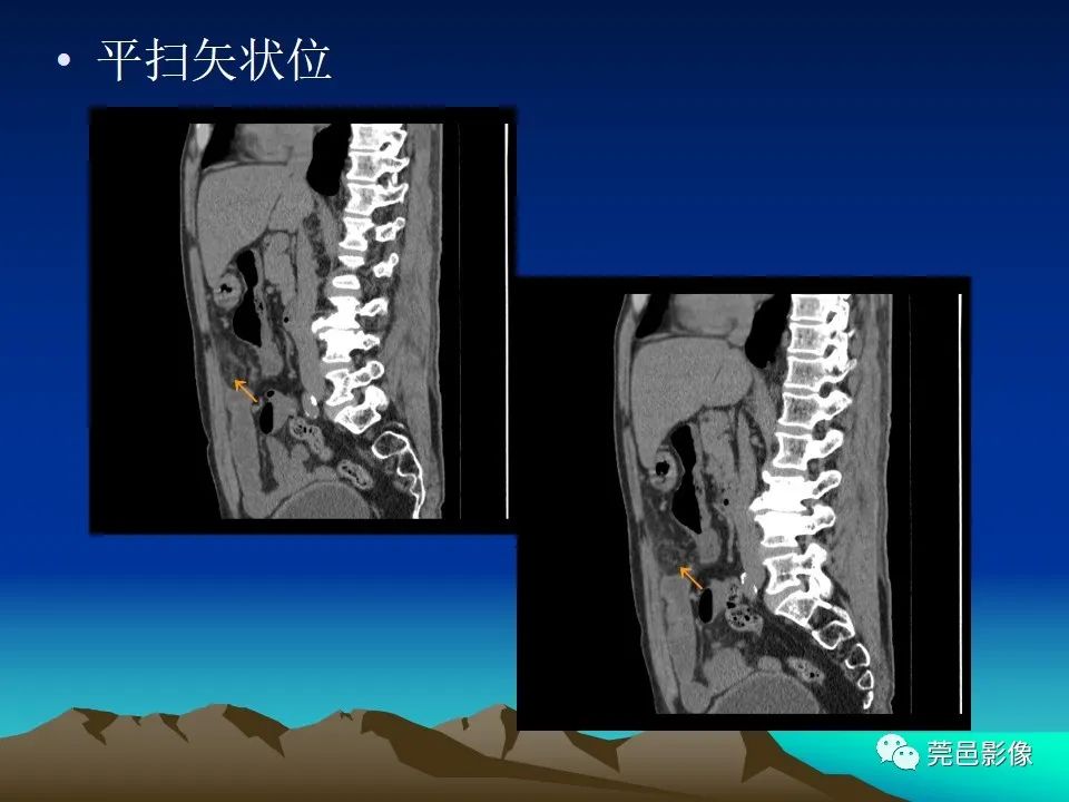 影像PPT - 【病例】大网膜扭转2例CT影像表现-7