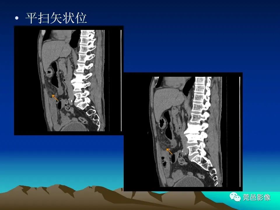 影像PPT - 【病例】大网膜扭转2例CT影像表现-8
