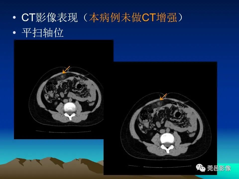 影像PPT - 【病例】大网膜扭转2例CT影像表现-10