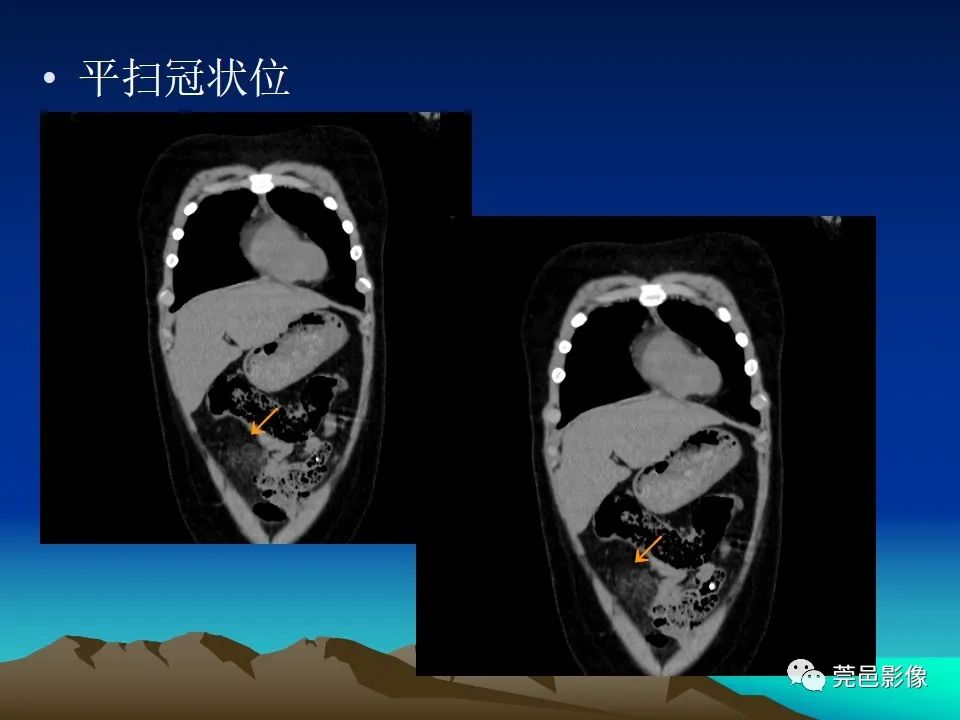 影像PPT - 【病例】大网膜扭转2例CT影像表现-12