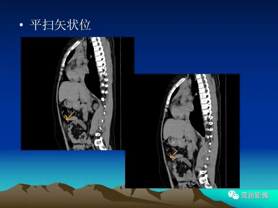 影像PPT - 【病例】大网膜扭转2例CT影像表现-14