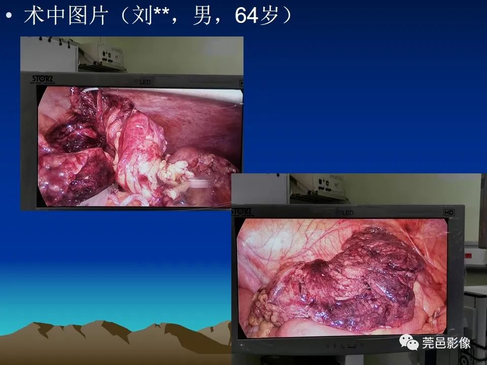 影像PPT - 【病例】大网膜扭转2例CT影像表现-17