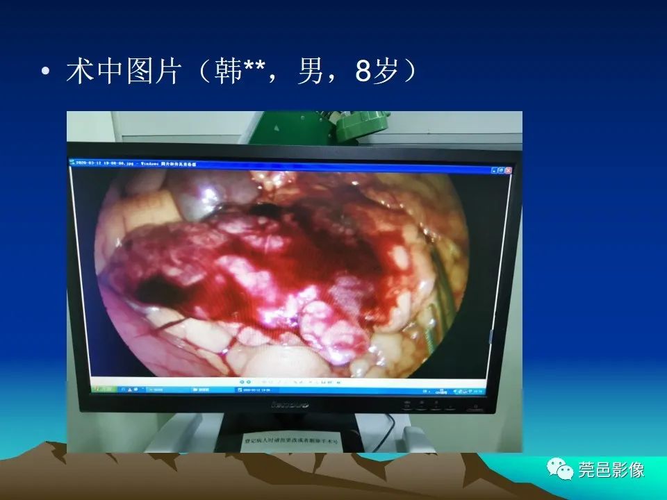 影像PPT - 【病例】大网膜扭转2例CT影像表现-18