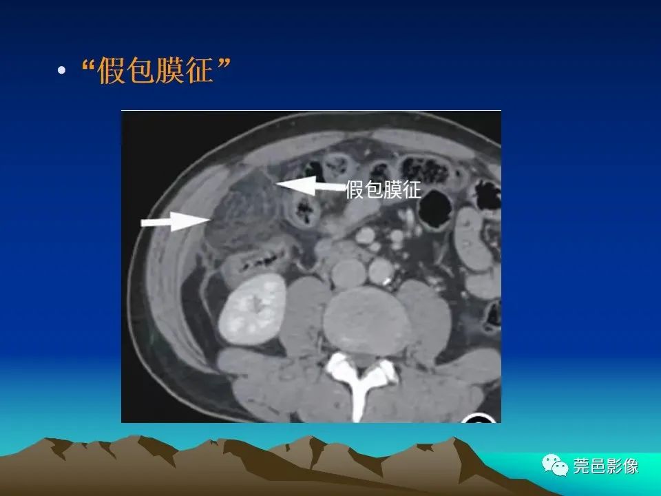影像PPT - 【病例】大网膜扭转2例CT影像表现-24