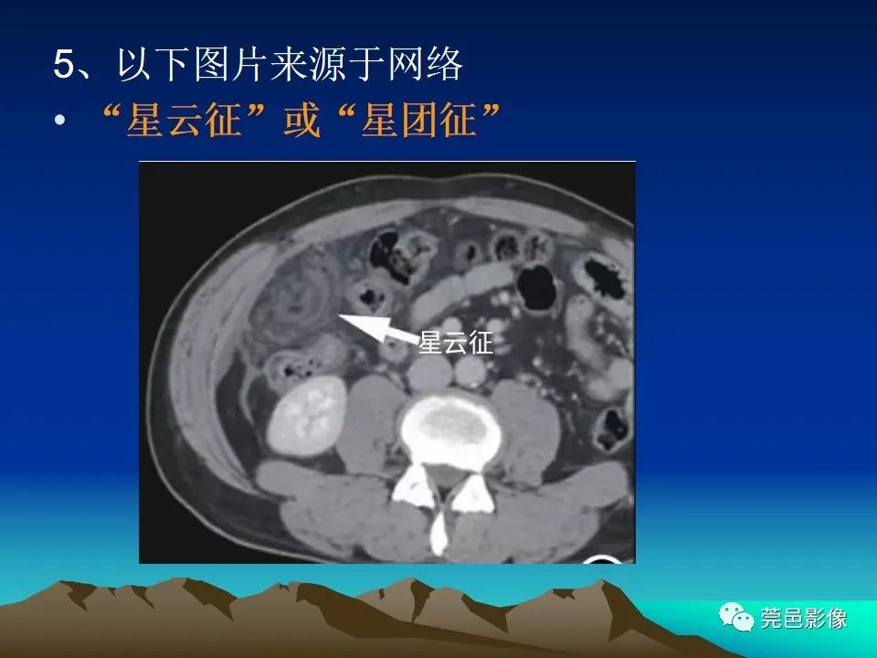 影像PPT - 【病例】大网膜扭转2例CT影像表现-23