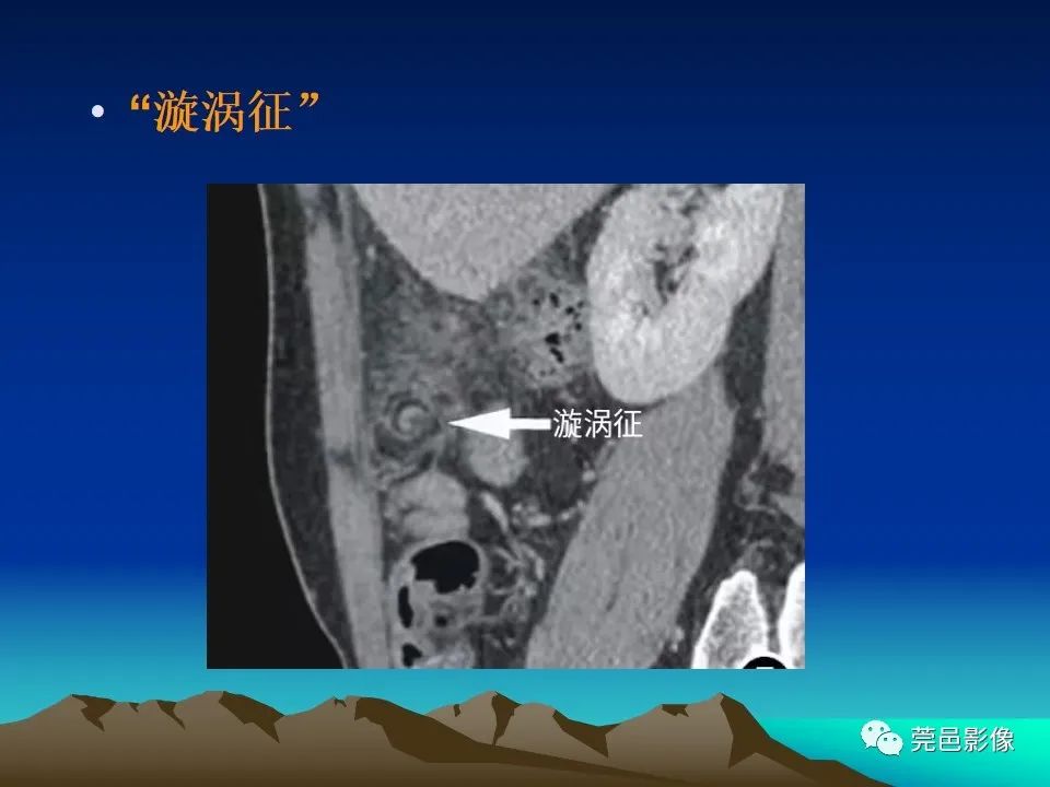 影像PPT - 【病例】大网膜扭转2例CT影像表现-25