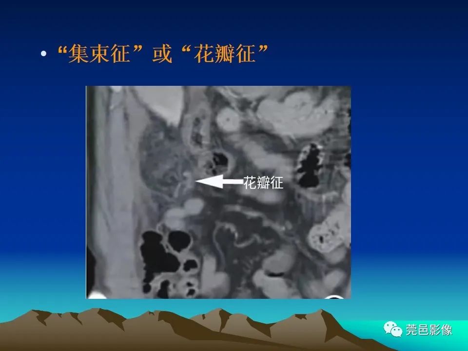 影像PPT - 【病例】大网膜扭转2例CT影像表现-26