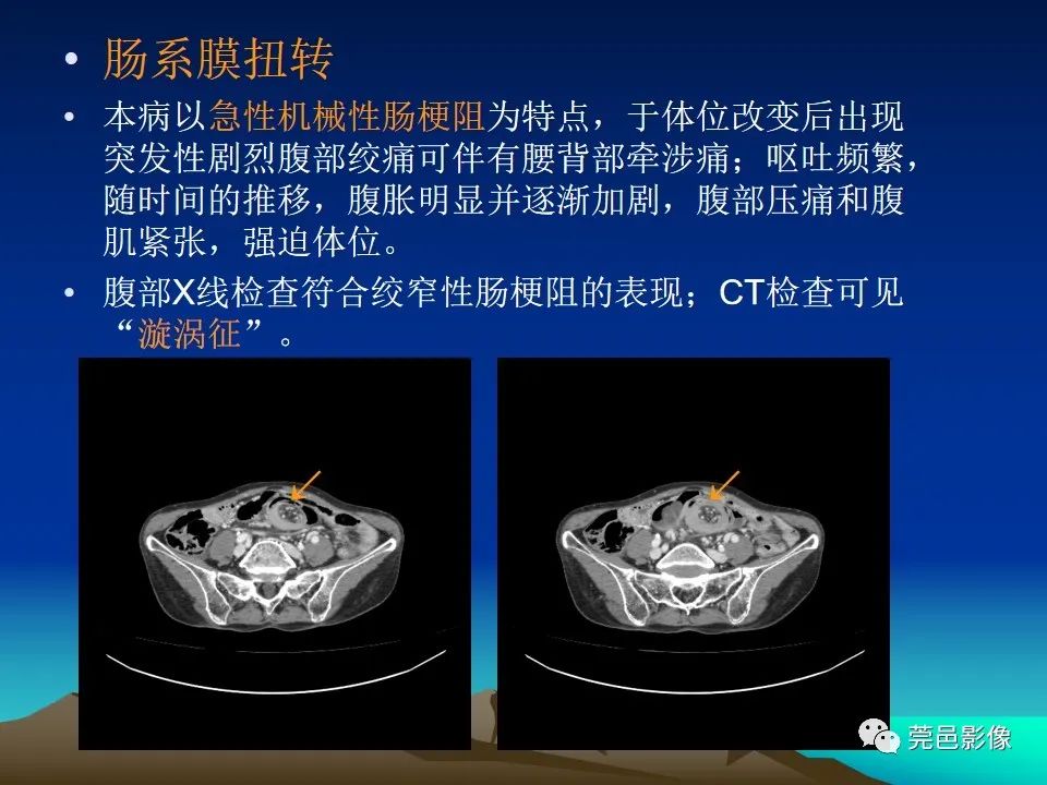 影像PPT - 【病例】大网膜扭转2例CT影像表现-28