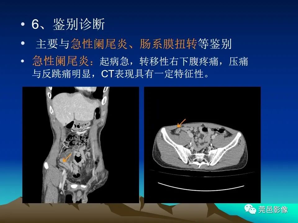 影像PPT - 【病例】大网膜扭转2例CT影像表现-27