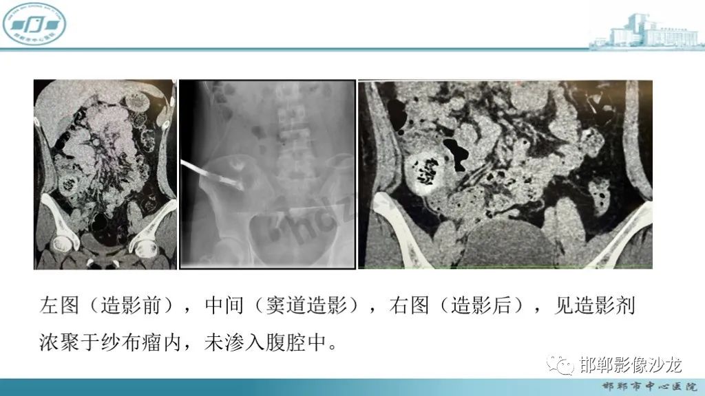 影像PPT - 腹腔内的“蜂窝征”-4 影像PPT - 腹腔内的“蜂窝征”-4