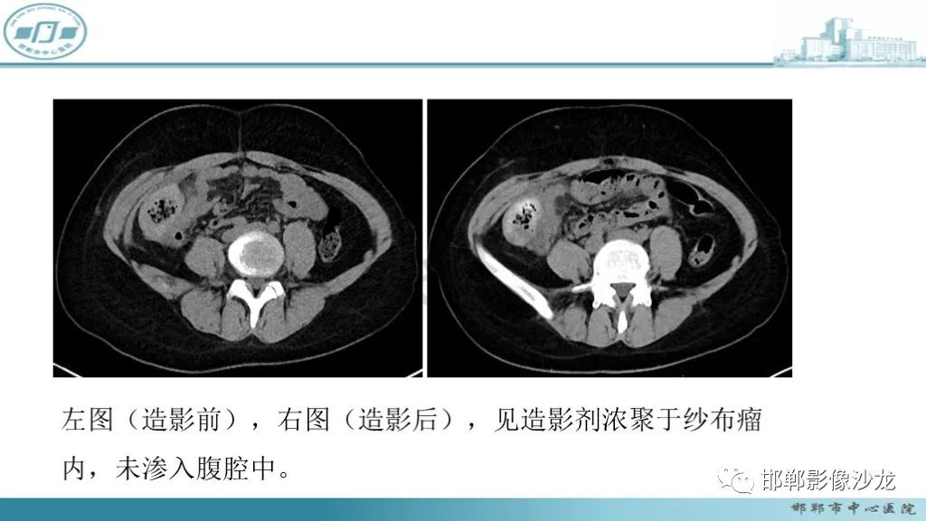 影像PPT - 腹腔内的“蜂窝征”-5 影像PPT - 腹腔内的“蜂窝征”-5