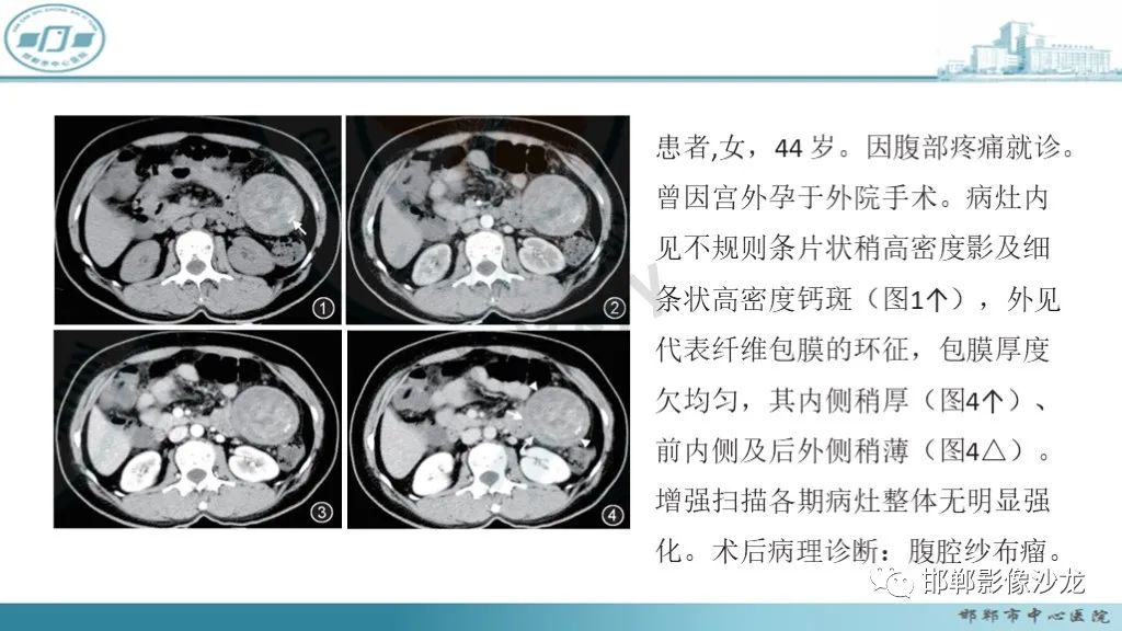 影像PPT - 腹腔内的“蜂窝征”-14 影像PPT - 腹腔内的“蜂窝征”-14